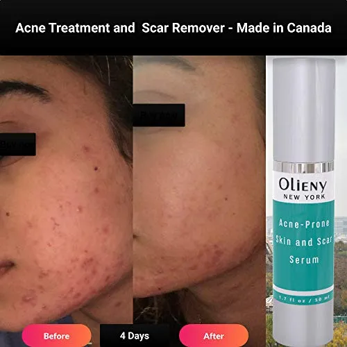 Acne spot Treatment Skin Serum Vitamin C, E and niacin amide Vitamin B3, B5, Acscanex for scars remove 50ML plus Face Cleanser 120Ml FREE